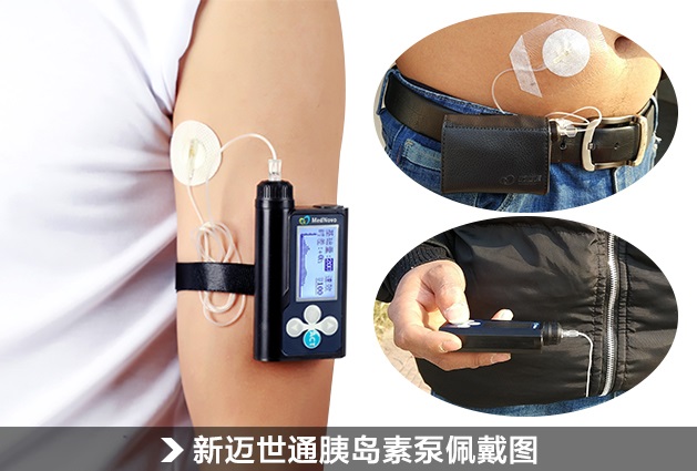 迈世通胰岛素泵佩戴图片